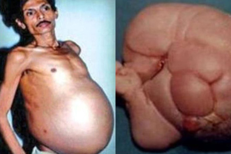  "Hamilə" kişi   mədəsində  əkiz qardaşı ilə YAŞAYIB 