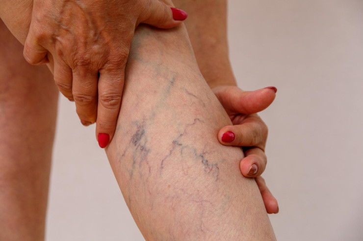 Trombozun qarşısının alınmasının effektiv  YOLU AÇIQLANDI 