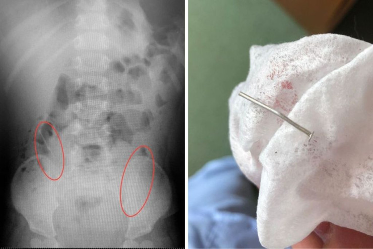 Bir yaşlı uşaq bir neçə  mismar uddu   və...