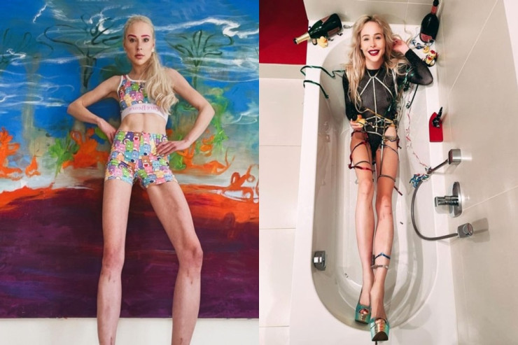 Gözəl görünmək üçün ayaqlarını  14 santimetr   uzatdırdı