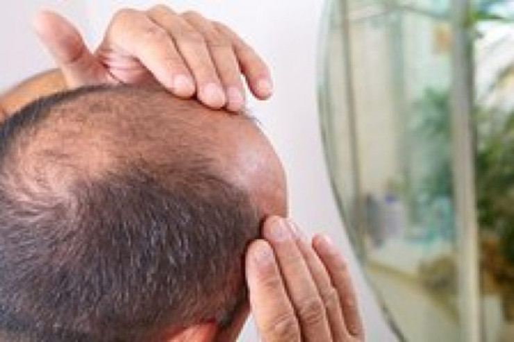 Piylənmə ilə  keçəllik arasında   əlaqə aşkar edildi