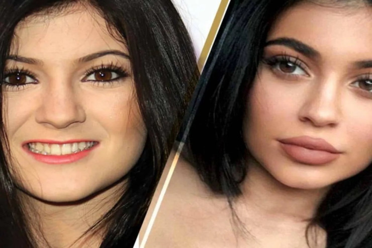 Ulduzlar  estetik əməliyyatdan   öncə və sonra