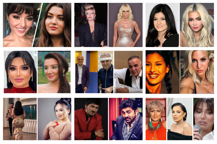 Plastik əməliyyatlardan sonra başqa birinə çevrilən ulduzlar - SİYAHI 