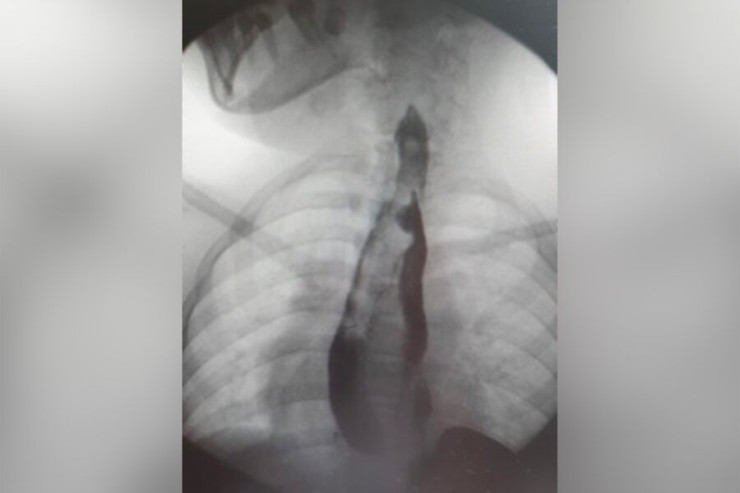 İki mədəsi  olan qız əməliyyat olundu