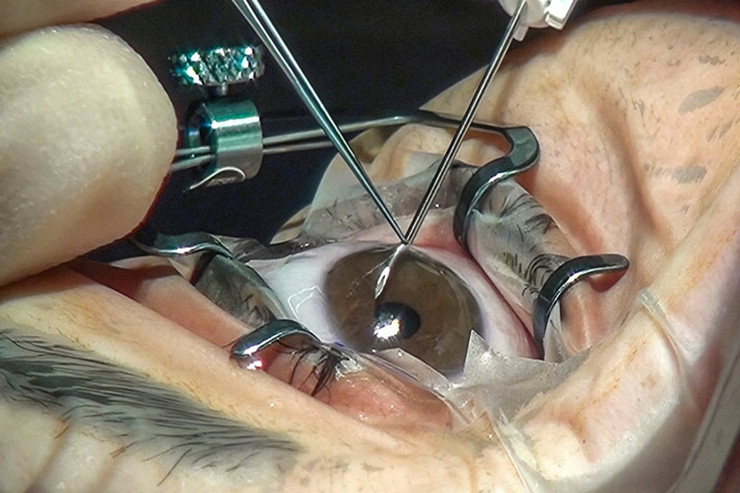 Məşhur müğənninin estetik əməliyyatlardan sonra  gözləri yumulmur 