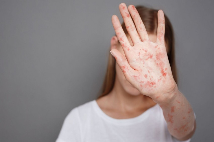 Qızılcaya daha bir KÜTLƏVİ YOLUXMA:  10 tələbə... - YENİLƏNİB 