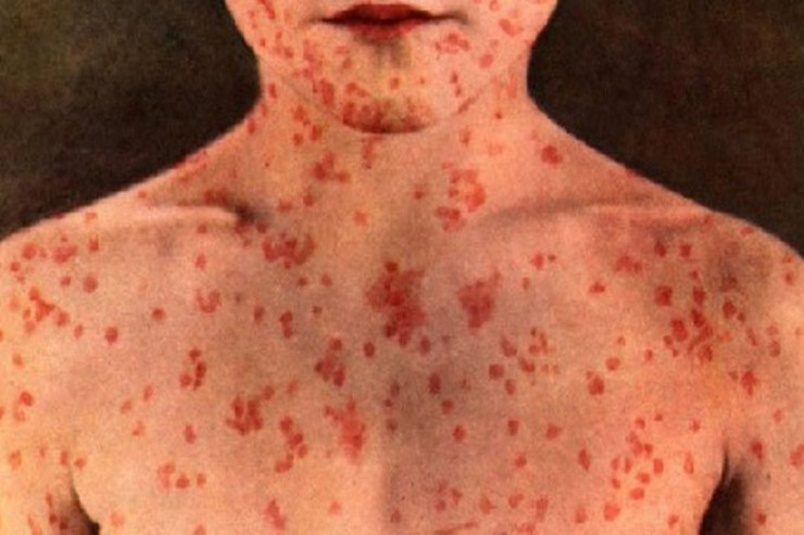 TƏBİB-dən qızılca ilə bağlı AÇIQLAMA 