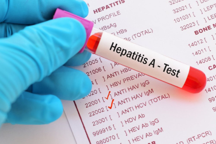 Azərbaycanda hepatit A virusuna yoluxma müşahidə edilir - RƏSMİ 