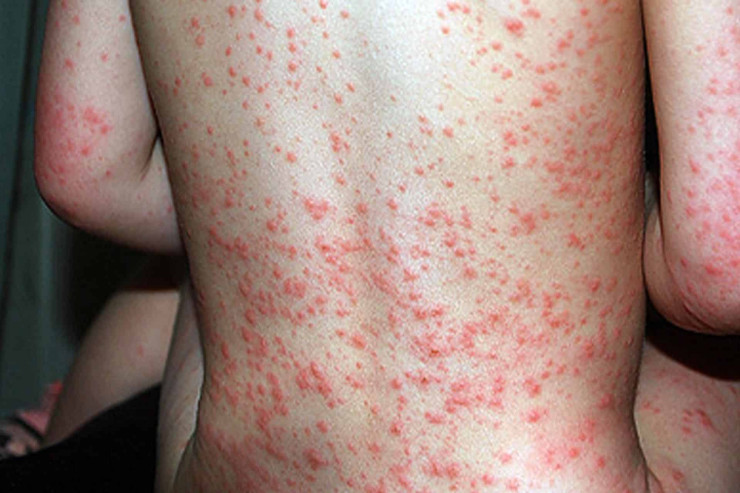 Azərbaycanda qızılcaya yoluxma PİK HƏDDƏ ÇATDI:  284 nəfər...