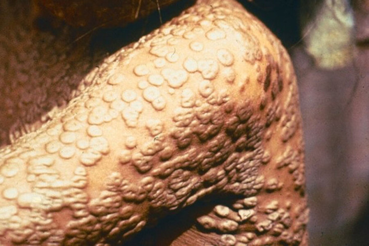 Dünyada çiçək xəstəliyi  harada saxlanılır?