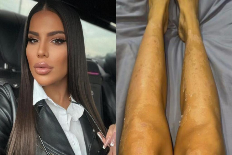 Bədəni çürüyən azərbaycanlı model yaralarını göstərdi