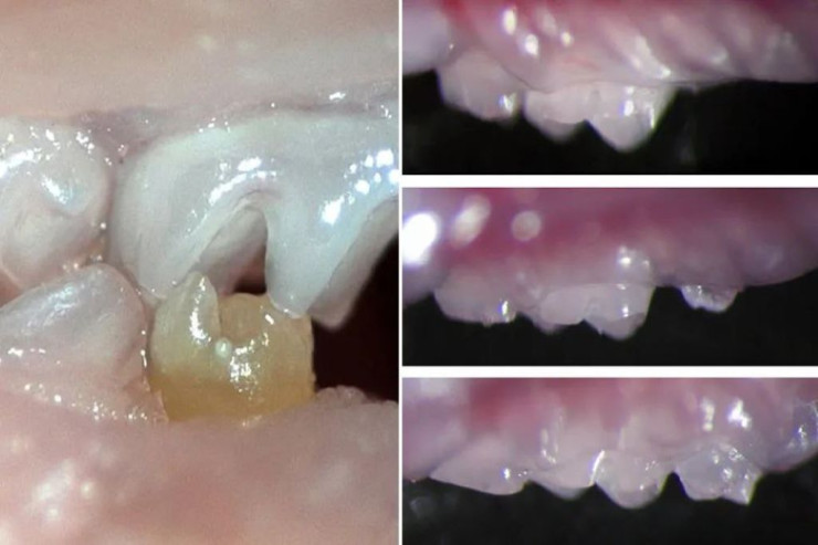 Bu dərman yeni dişlərin çıxmasına kömək edir - PROTEZƏ EHTİYAC QALMAYACAQ 