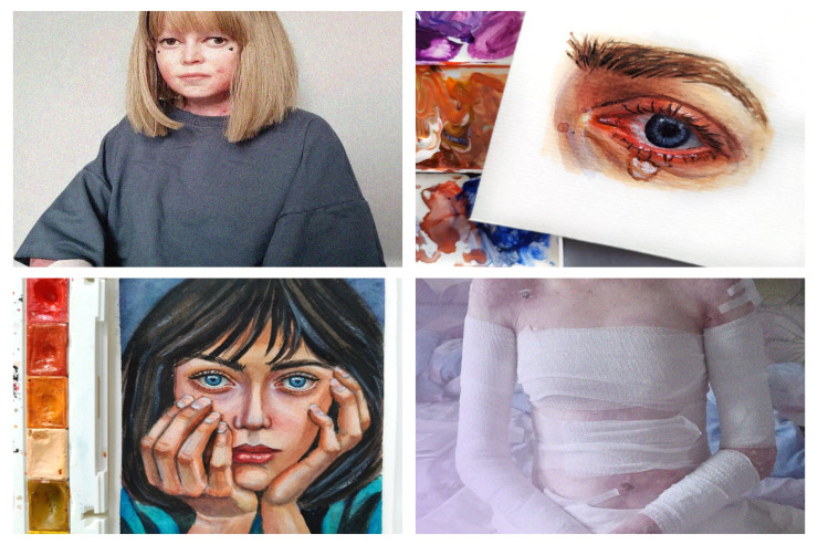 Kəpənək xəstəliyi   olan QIZ: barmaqları tökülüb, toxunan kimi yaralanır