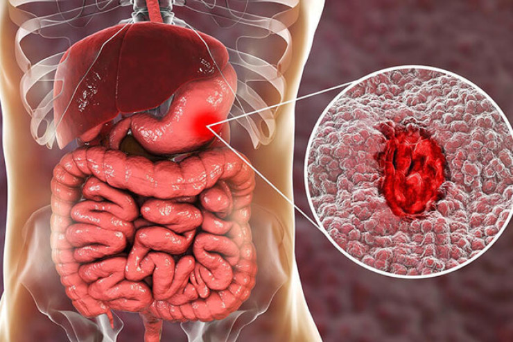 Xora xəstəliyi necə yaranır? - Həkimlə müsahibə 