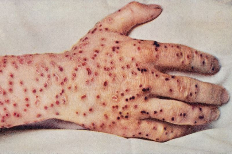 Azərbaycan meymunçiçəyinə görə  HƏRƏKƏTƏ KEÇDİ