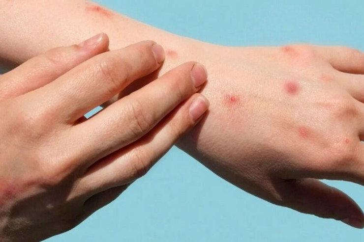 "Meymunçiçəyi nə COVID-19-dur,  nə də onun ştammı" - ÜST rəsmisi