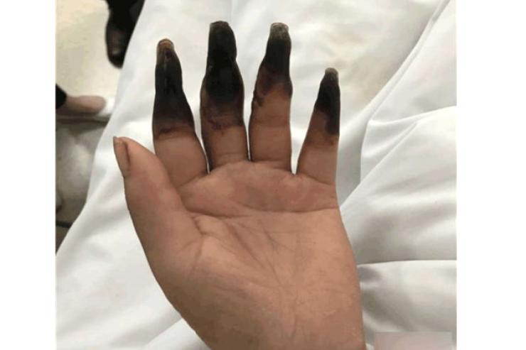 Yalnış diaqnoza görə barmaqlarını itirdi 