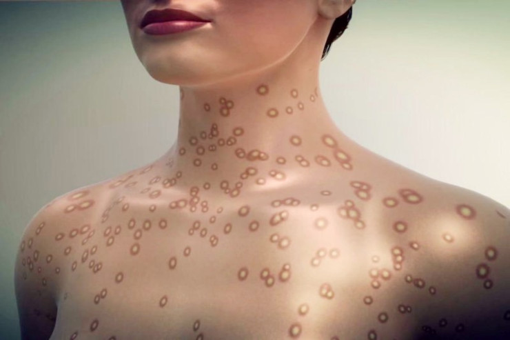 Bu ölkədə  sifilisə yoluxmada   rekord artım