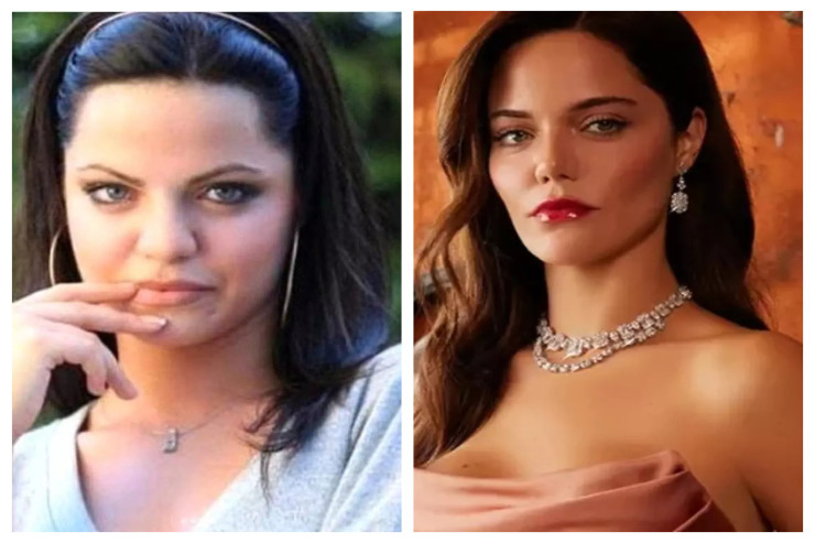 Məşhur aktrisadan  estetik əməliyyatlarla   bağlı ETİRAF