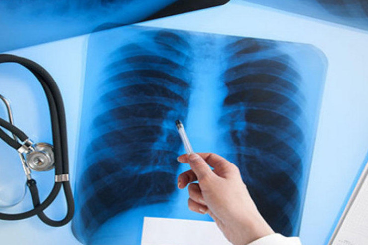 Yayılan öskürəyin səbəbi nədir? - CAVAB 