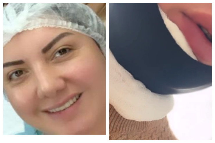 Nazilə Səfərli yenidən plastik əməliyyat  keçirdi