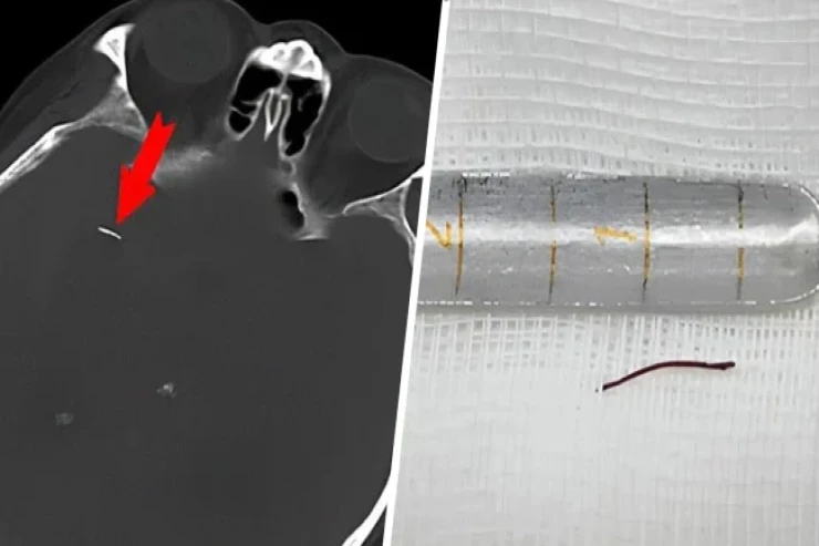 Kişi beynindəki iynə ilə  20 İL YAŞADI  