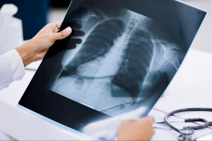 Süni intellekt döş qəfəsinin rentgenoqrafiyasından insanın yaşını təxmin edə bilər