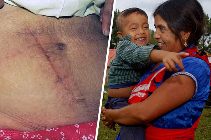 Qadın özünü  qeysəriyyə əməliyyatı   edib doğdu