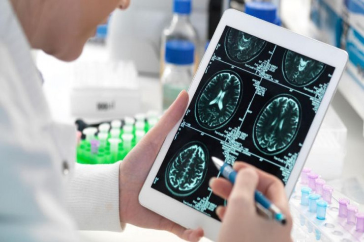 Alzheimer xəstələrində beyin hüceyrələrinin ölüm səbəbi məlum oldu