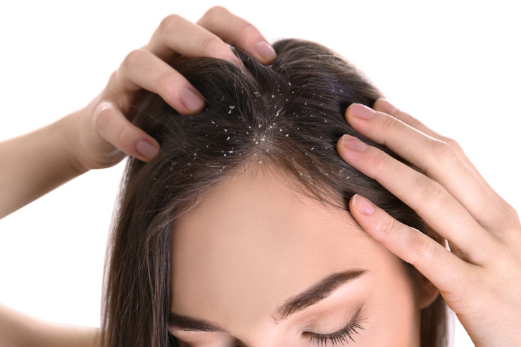 Saçlarınız kəpəklənir?  – Belə qurtulun