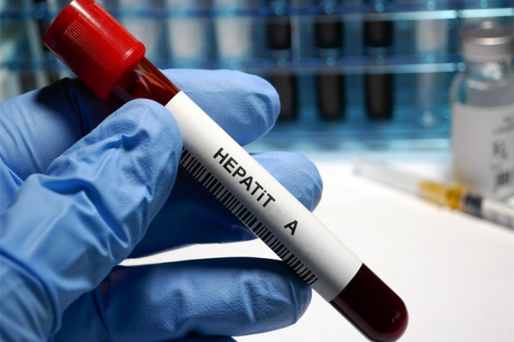 Hepatit A virusuna necə yoluxmaq olur? - HƏKİM AÇIQLADI 