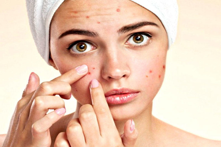 Sızanaqlarla təbii vasitələrlə MÜBARİZƏ EDİN  