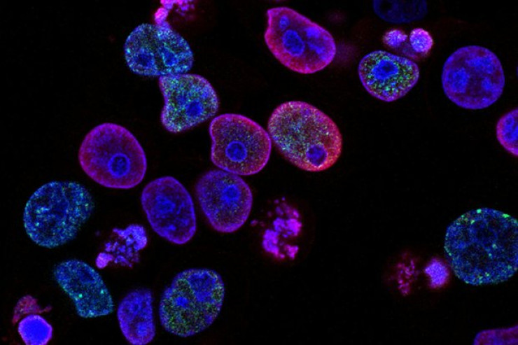 Qızıl nanozərrəciklərin xərçəngi məhv etdiyi  məlum olub