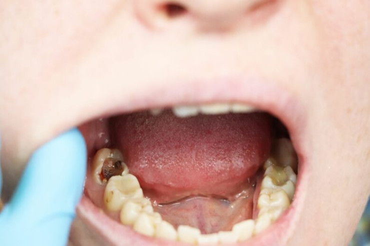 Diş həkimi hər kəsə daha çox pendir  yeməyi tövsiyə edir - SƏBƏBİ 