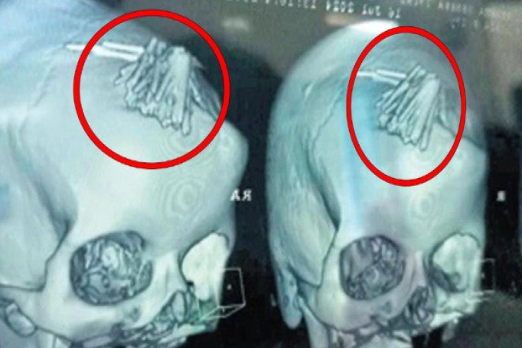 Həkim cadudan xilas etmək üçün pasiyentin başına 77 iynə soxdu 