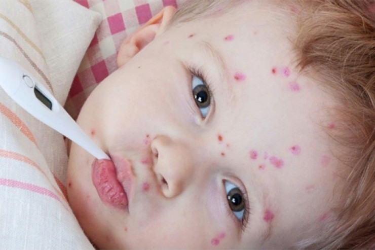 Azərbaycanda 13 mindən çox uşaq qızılcaya yoluxdu 