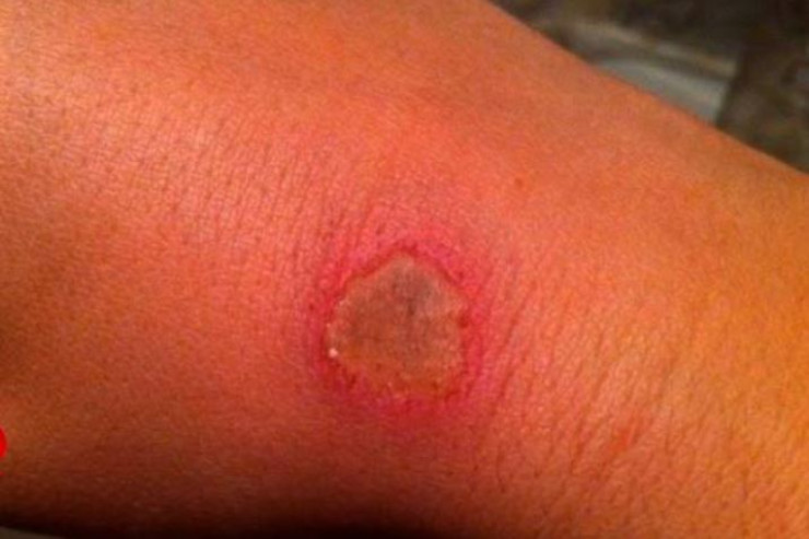 Zaqatalada “Qarayara”ya yoluxanlarla   bağlı YENİ XƏBƏR