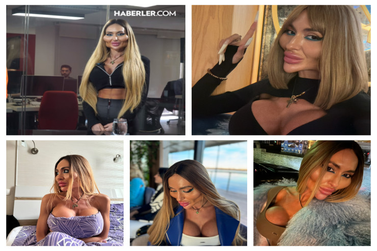 Dünyanın ən böyük  yanaqlı xanımı   görün nələr danşdı