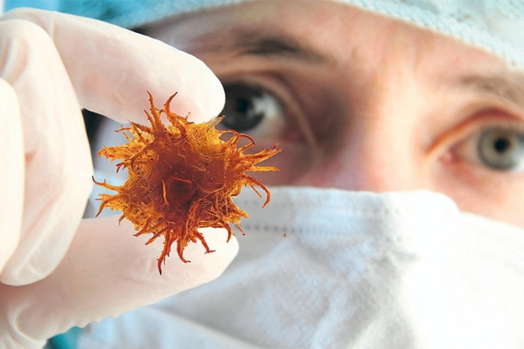 Xərçəngdən öləcəkdi:  qeyri-adi müalicədən  sonra sağaldı