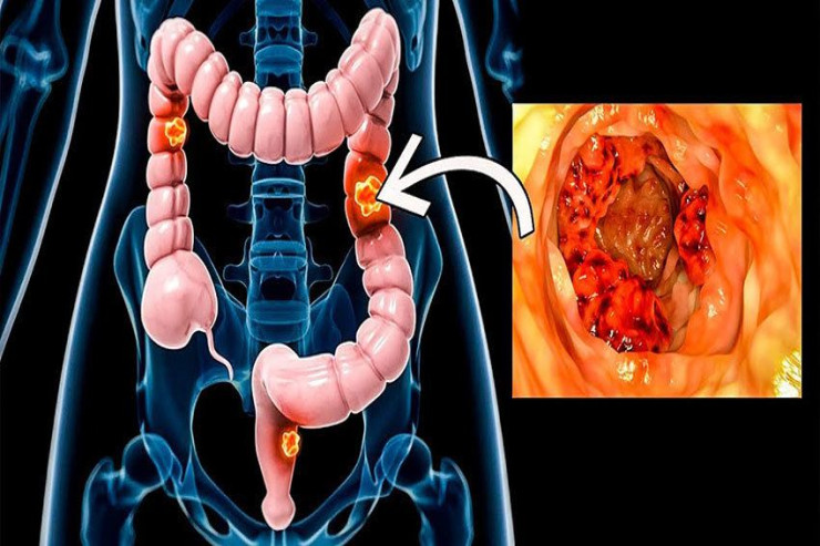 Bağırsaq xərçənginin ilk əlamətləri barədə XƏBƏRDARLIQ 
