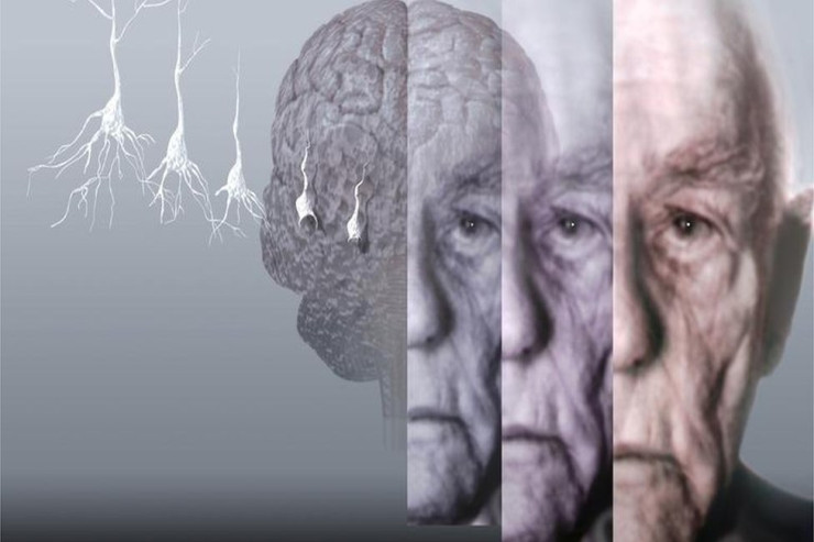  Alzheimer xəstəliyinin   yeni səbəbi TAPILDI