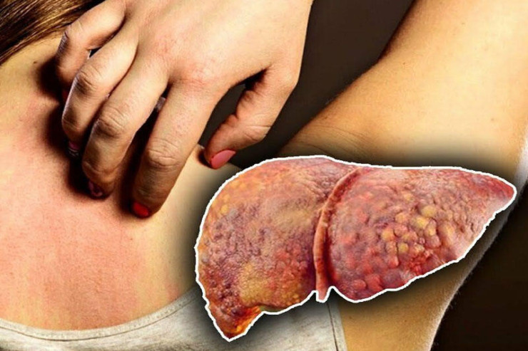 Bu üç əlamət  qaraciyər problemindən   xəbər verir