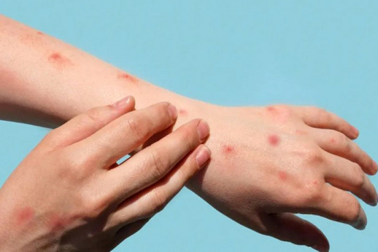  Qızılcaya   yoluxma kəski artdı