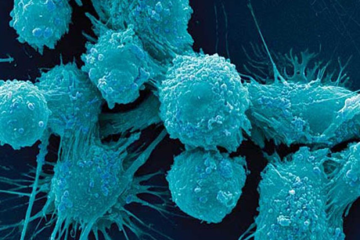 Xərçəngdən necə qorunmalıyıq? - Xəstəlik riskini azaldan 5 qida 