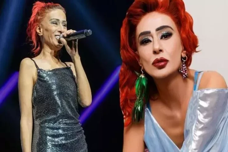 Üzü yanan Yıldız Tilbe  elə dəyişdi ki... – Tanımayacaqsınız 