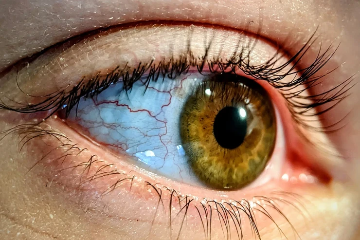 Göz damarları Altsheymer xəstəliyini  aşkarlamağa kömək edə bilər