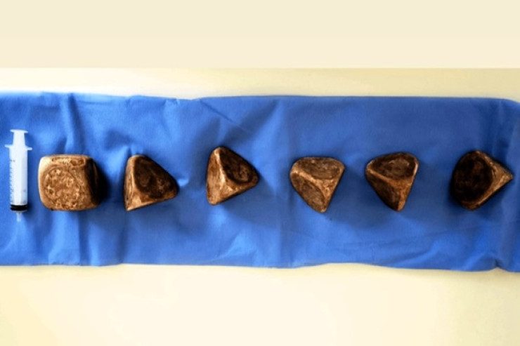 Kişinin sidik kisəsində 2 kilo daş  tapıldı