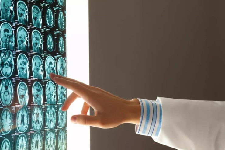 XƏBƏRDARLIQ : Bu göbələk beyini öldürür