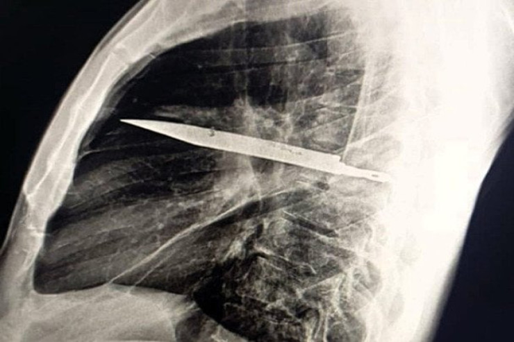 8 il sinəsində bıçaqla yaşayıb:  bundan xəbəri olmayıb