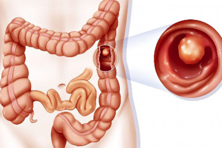 Həkimlərdən TÖVSİYƏ:  bağırsaq xərçəngi riskini azaldan qaydalar